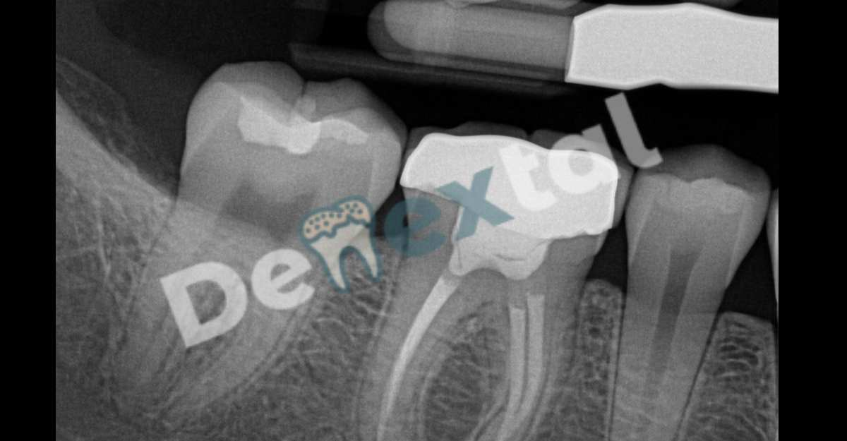 Infected Root Canal Xray