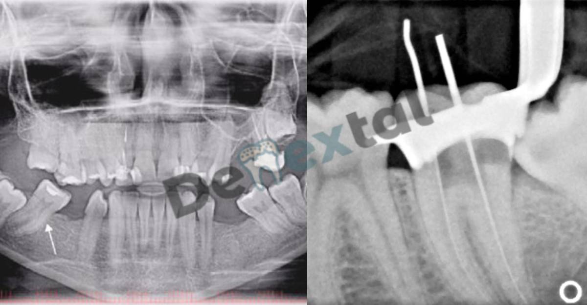 Root  Canal Xray