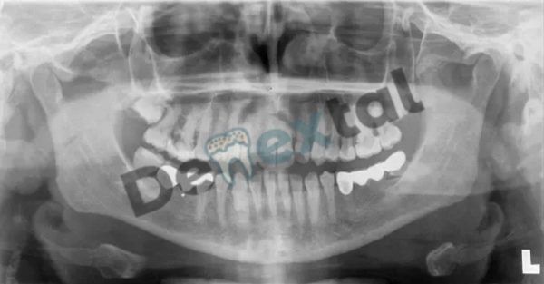 How to Read Dental X-rays