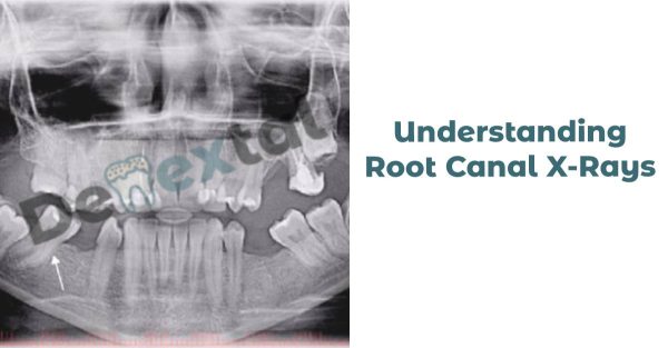 Root Canal X-Rays