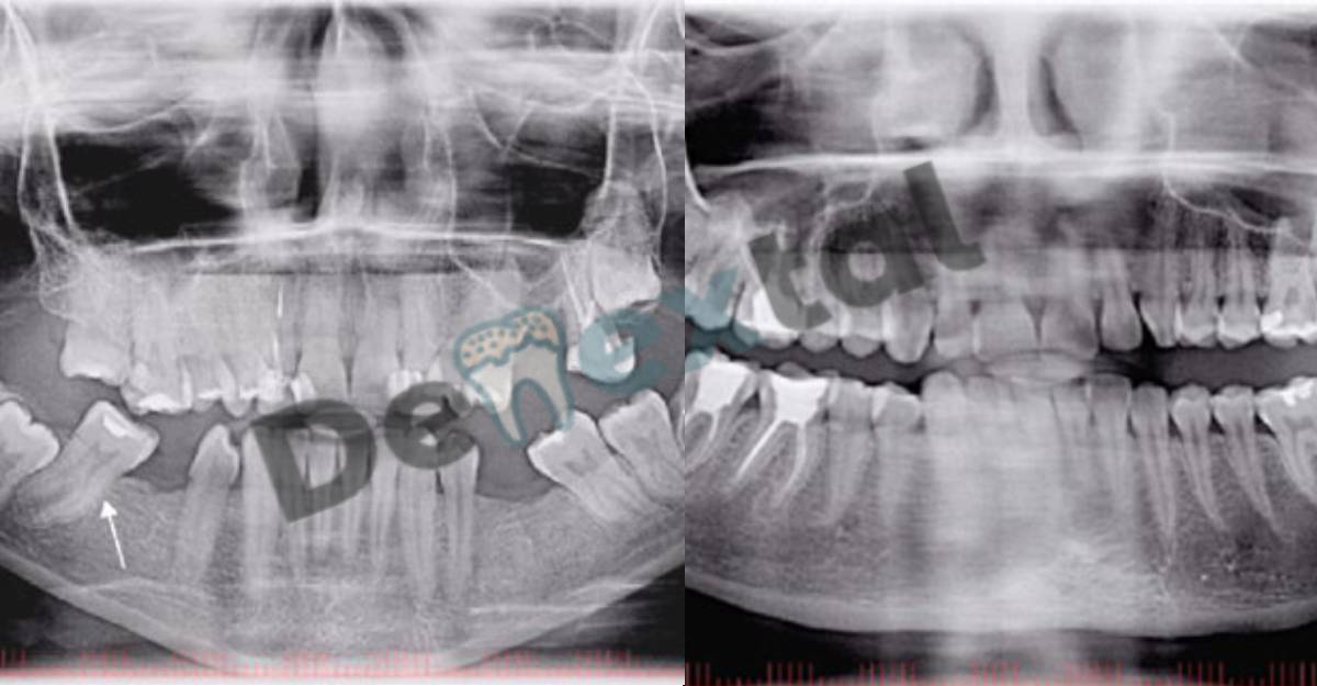 Understanding Tooth Pain But Nothing Shows Up On X-ray