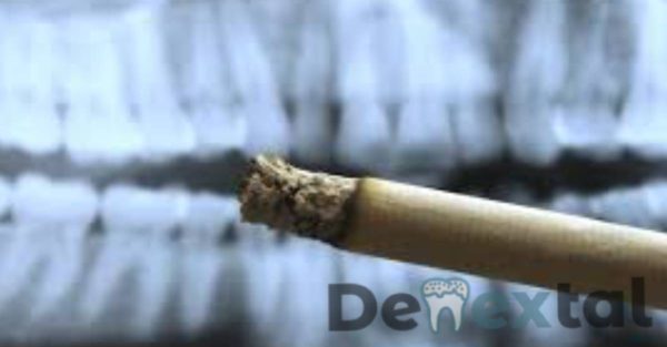 Can you smoke after a root canal