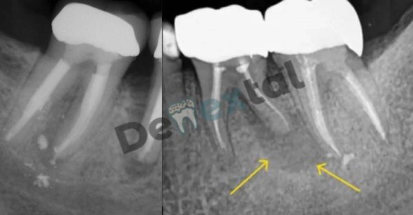 Root Canal Failure