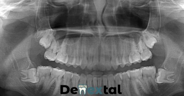 bone graft wisdom teeth