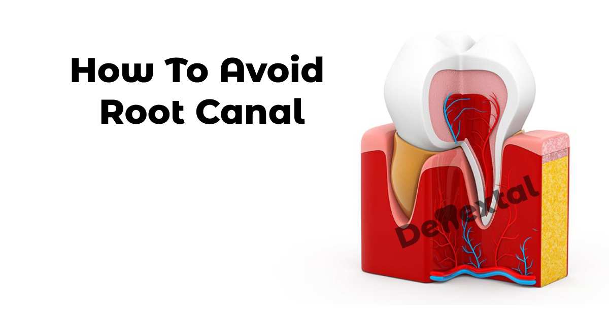 how to avoid root canal