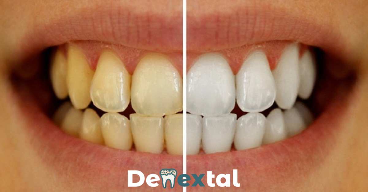 Teeth Cleaning Before and After