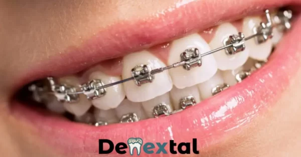 Teeth Contouring After Braces