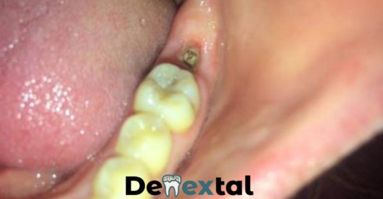 Wisdom Tooth Extraction Infection A Comprehensive Guide Denextal Connecting With Angels